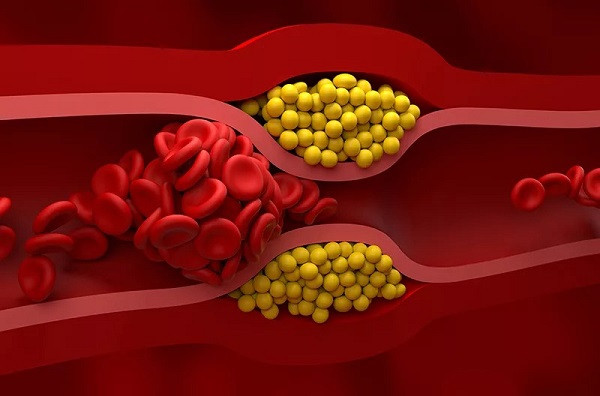 High Cholesterol Reducing Tips