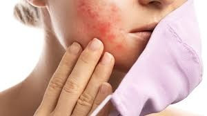 Malassezia infection monsoon