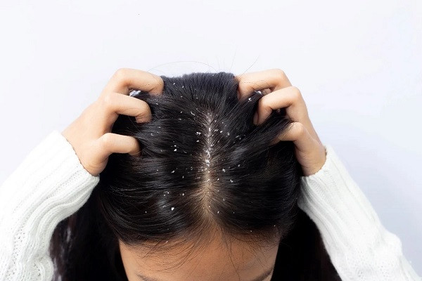 Reduce your Dandruff Problems