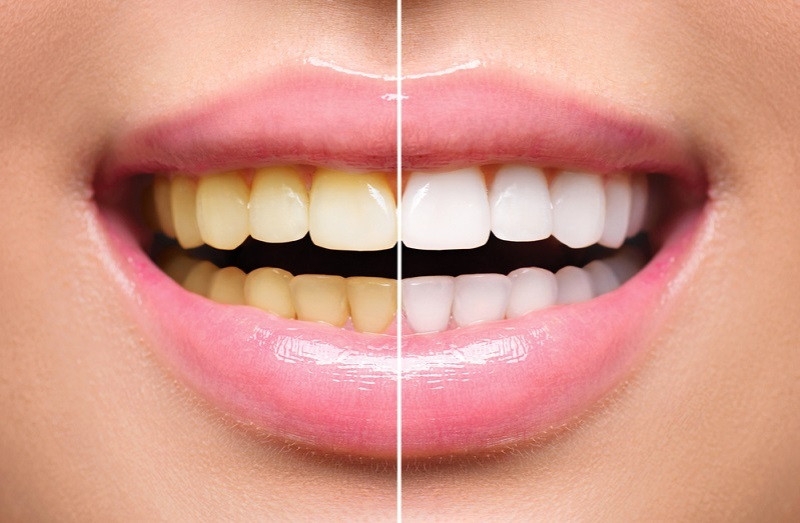 yellow teeth causes and dentalhealth tips